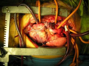 transplantácia