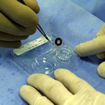 Na snímke detail implantátu aniridickej šošovky