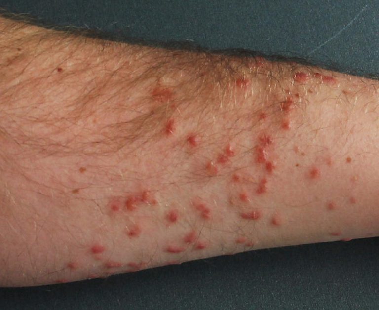 cerkáriová dermatitída